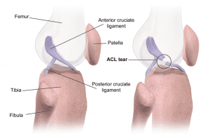 THE ACL: WHAT IT IS, HOW IT’S INJURED, AND HOW TO REDUCE THE RISK OF INJURY!