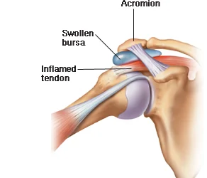 Top 3 Causes of Shoulder Pain
