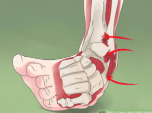 Ankle Sprain Tips